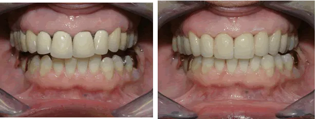 Comparaison avant/après entre une armature métallique et une armature Zircone
